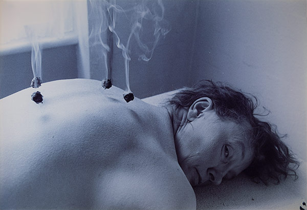 Jo Spence, Alternative Health Treatment using Traditional Chinese Medicine (with Maggie Murray) from The Picture of Health, 1982-1986 © Terry Dennett and courtesy of the Jo Spence Memorial Archive, Ryerson Image Centre, Toronto